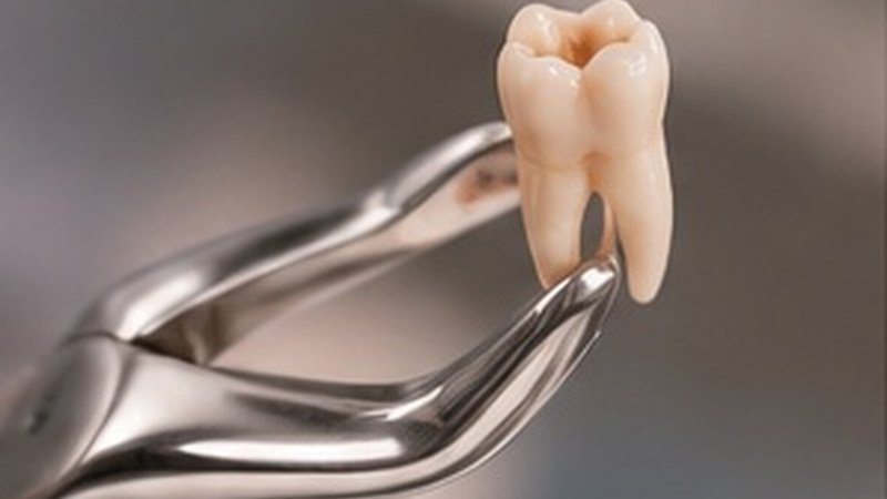 Tannuttrekking – skånsom fjerning av tann hos Dentix Tannhelse